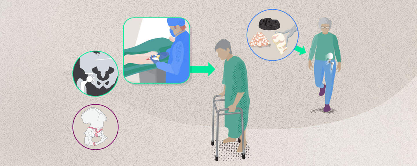 Total hip arthroplasty after acetabular fractures