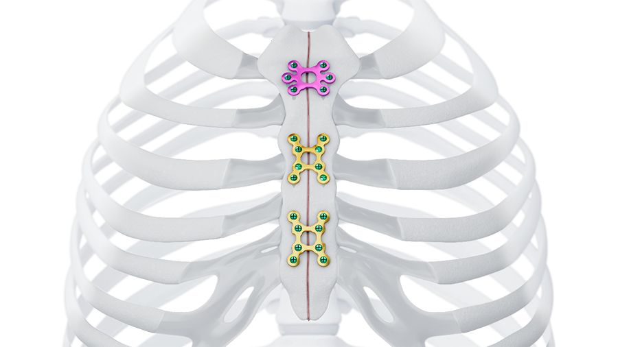 MatrixSternum_promo