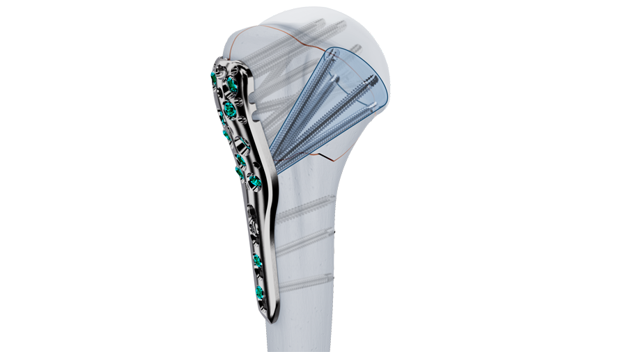 VOLT Proximal Humerus